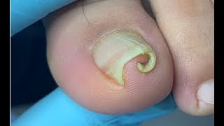 How to repair curled nail [upl. by Philippe]