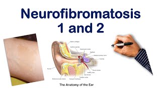 Neurofibromatosis NF 1 2 Mnemonic  USMLE STEP COMLEX NCLEX [upl. by Baese192]