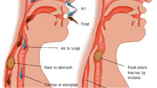 Aspiration Pneumonia [upl. by Brunhild]