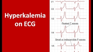 ECG Interpretation T wave Changes Part VII [upl. by Flemings]