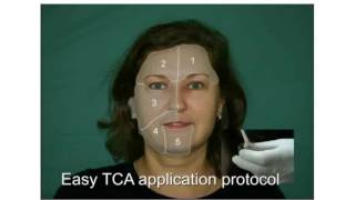 Skin Tech guide for patients Easy TCA treatment [upl. by Aifos861]