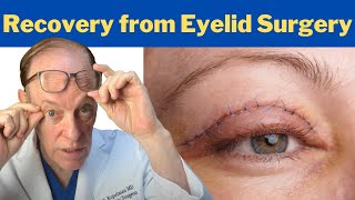 How to Recover from a Blepharoplasty  Plastic Surgeons Guidance on Eyelid Surgery Recovery [upl. by Reneta]