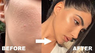 HOW I GOT RID OF STUBBORN BUMPS AND TEXTURED SKIN [upl. by Matty]