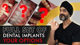 OPTIONS WITH A FULL SET OF DENTAL IMPLANTS  What You Need to Know [upl. by Kablesh824]