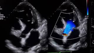 RWMAModerate LV DysfunctionTrace pericardial effusionpleural effusion cardioheartcondition [upl. by Ynohtna]