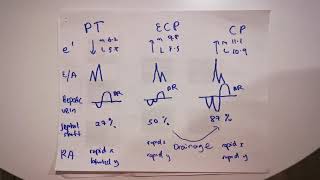 Constrictive pericarditis vs effusive constrictive pericarditis vs pericardial tamponade [upl. by Yelir]