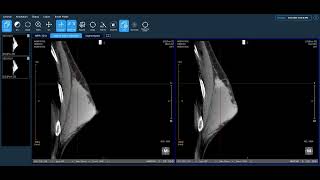 Koning Clinical Case Review Invasive Ductal Carcinoma Extremely Dense Breast [upl. by Mab]