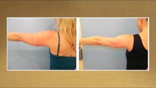 Laser Lipo for Slimmer Arms  Testimonial [upl. by Eive]