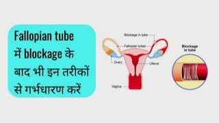 Fallopian tube blockage causes symptoms and treatment fallopiantubeblockage fallopiantube [upl. by Lubet781]