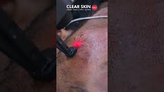 Revitalize your skin with CO2 fractional laser treatment Say goodbye to acne scars  Clear Skin [upl. by Dun]