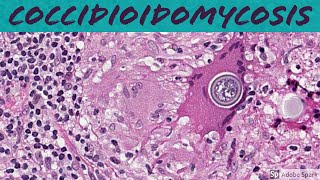 Coccidioidomycosis Coccidioides 5Minute Pathology Pearls [upl. by Svoboda355]