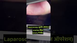 Ovary cyst laparoscopy operation how obstetrician trending cutebaby obstetrics neet neet2024 [upl. by Atteoj]