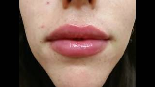 Lip AugmentationInjections with Juvederm Ultra Plus by Dr Jonathan Lebowitz Long Island New York [upl. by Denis]