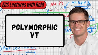 Polymorphic Ventricular Tachycardia  Day 23 ECG Challenge [upl. by Naerda]