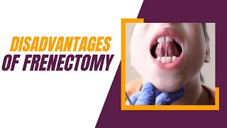 8 Disadvantages of Frenectomy and It’s Important Benefits [upl. by Ellehcirt411]