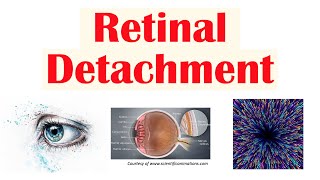 Retinal Detachment  Types Risk Factors Pathophysiology Signs amp Symptoms Diagnosis Treatment [upl. by Grote]