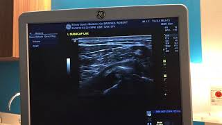 Ultrasound Guided Barbotage Procedure for Calcific Tendonitis in Shoulder [upl. by Acirret]