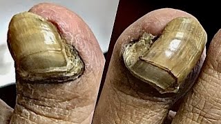 Extremely THICK and Sensitive NAIL CUTTING Patient Had To Be Numbed [upl. by Vevay311]