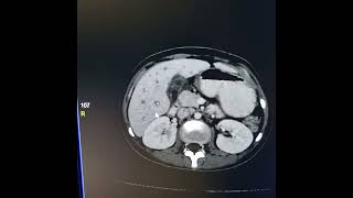 Liver abscess  Periportal haloPeriportal collar sign [upl. by Kori]