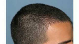 FUE hair transplant hairline example by Dr Paul Shapiro of Shapiro Medical Group [upl. by Critta]