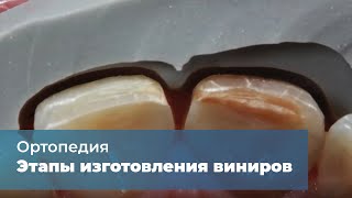 Клинические этапы изготовления виниров [upl. by Brendin150]