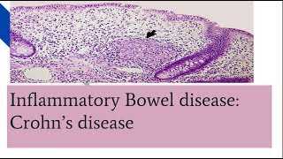 Crohns disease PathogenesisMorphology and clinical features [upl. by Euf]