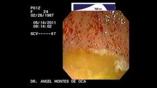 ENDOSCOPIA GASTRITIS EROSIVA NGELMED [upl. by Lorri]