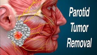 Parotid Mass Removal and Facial Nerve Considerations Parotidectomy [upl. by Etrem430]