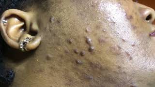 keloid amp hypertrophic acne scars [upl. by Mechling]