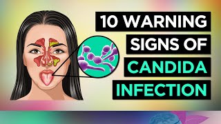 10 Symptoms of CANDIDA OVERGROWTH Yeast Infection [upl. by Dante183]