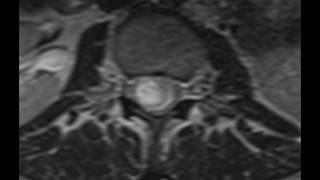 Intradural Schwannoma [upl. by Kirstyn]