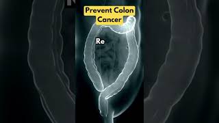 How Do You Prevent Colon Cancer [upl. by Dubenko784]