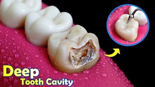 FANTASTIC Restoration Of Tooth Cavity By Root Canal And Composite Filling [upl. by Akemahs]