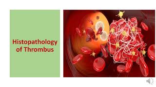 THROMBOSIS TYPES  HISTOPATHOLOGY CONSEQUENCES DIAGNOSIS AND PREVENTION [upl. by Bethina]