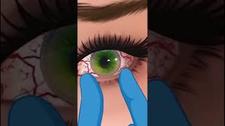 Eyes infection clinging 3D Animation ASMR Video Part2  infected eyes 🤢😷satisfying relaxing [upl. by Foulk]