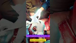 Pop cast for scaphoid bone fracture orthopedics shortvideo [upl. by Notsruht]