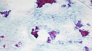 Pleomorphic adenoma Cytology [upl. by Emerson]