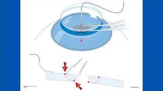 Corneal Suturing Part 2  Placing the Needle Into the Graft [upl. by Aicila108]