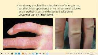 Lecture98 Primary Cutaneous Mucinosis Rooks chapter 59 [upl. by Niltak]