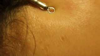 Blackhead extraction with Slow Motion HD  forehead zit [upl. by Stockwell118]