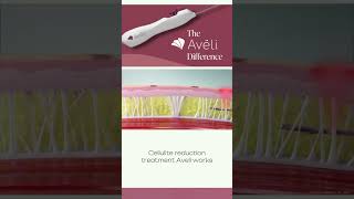 Curious about cellulite solutions Aveli got you 🌟 AveliTreatment CelluliteSolutions [upl. by Aicenev]