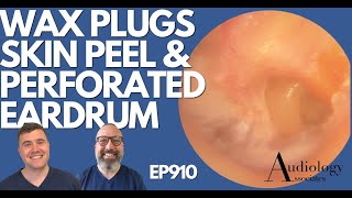 EAR WAX PLUGS SKIN PEEL amp PERFORATED EARDRUM  EP910 [upl. by Serge621]