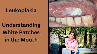 Leukoplakia Understanding White Patches in the Mouth [upl. by Prentice320]