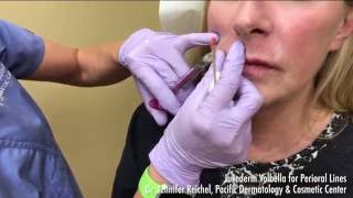 Juvederm Volbella Demo for Perioral Lines around the lips  2068595777 [upl. by Ong819]