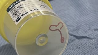 Parasitic worm found in womans brain [upl. by Drugi]