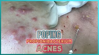 Big Cystic Acne Blackheads Extraction Blackheads amp Milia Whiteheads Removal Pimple Popping [upl. by Brandea]