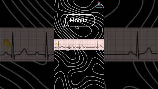 Second degree Heart block Mobitz 1 second degree Heart block Mobitz 2 [upl. by Bridwell803]