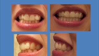 INVISALIGN Update Tray 21 last tray amp Refinements [upl. by Ttezil40]