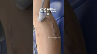 Super glue for your veins 3D Animation [upl. by Aleacin635]