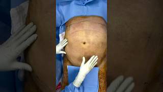 Lipoescultura con Lipotransferencia en paciente MASCULINO de 93 kg 💪🔥 cirugiaplastica lipo [upl. by Lashond]